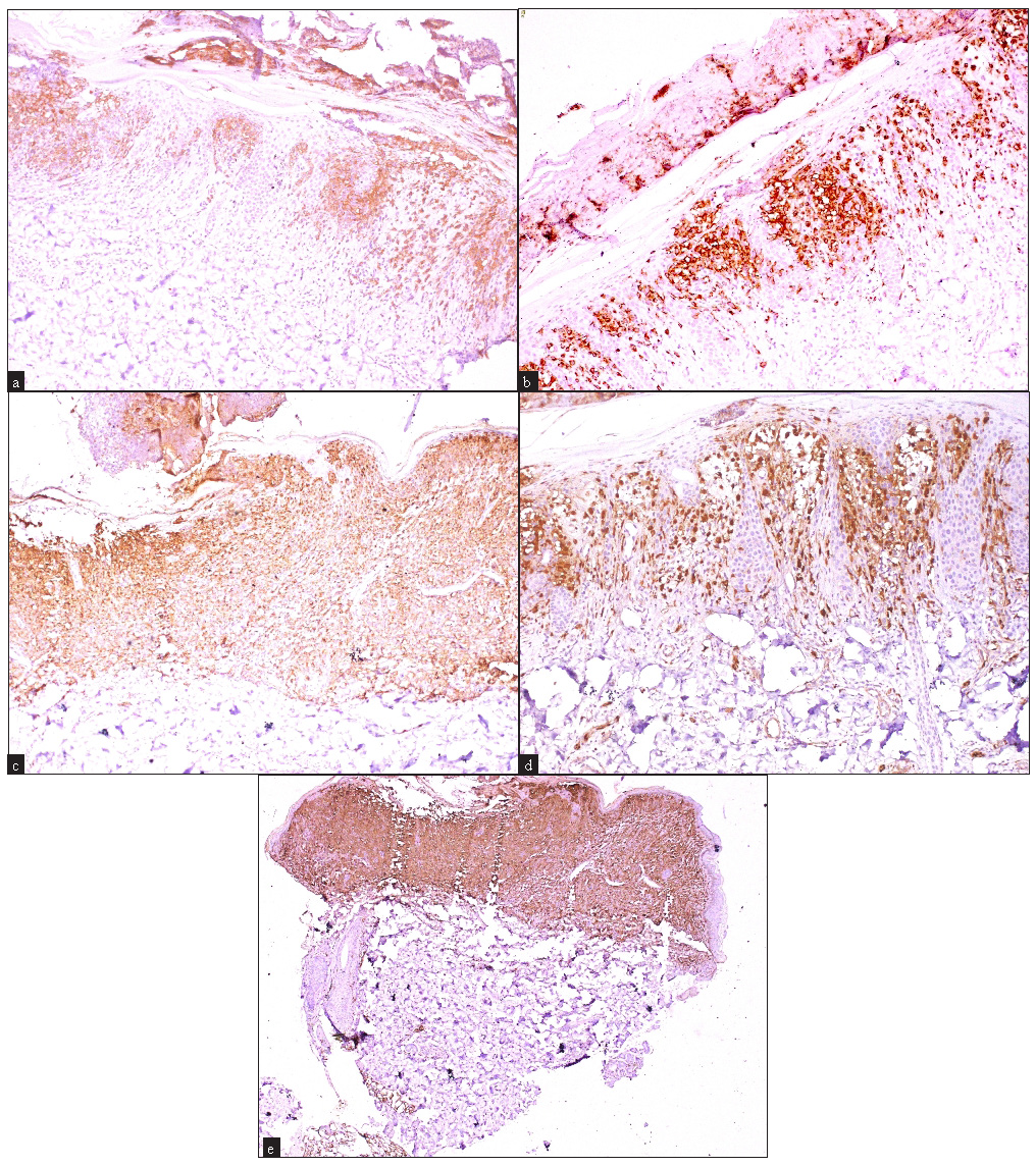 Immunohistochemistry findings showing (a) patchy (multifocal) epidermal and dermal CD1a positivity (100x), (b) patchy (multifocal) epidermal and dermal langerin positivity (100x), (c) epidermal and dermal confluent and dense langerin positivity in the papillary dermis (100x). (d) patchy (multifocal) epidermal and dermal S-100 positivity (100x) and (e) epidermal and dermal confluent and dense S-100 positivity in the papillary dermis (40x).