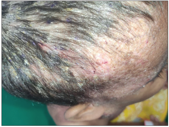 Scalp involvement in a 3.5 year old female child with multisystem LCH (MS-LCH) in the form of erythematous excoriated papules and yellowish semi-adherent scales.