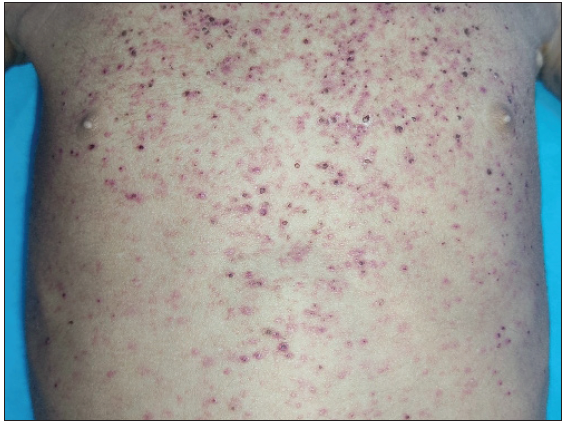 Discrete to coalescent erythematous and purpuric papules over the chest and abdomen with abdominal distension in a 4-year-old male child with MS-LCH.