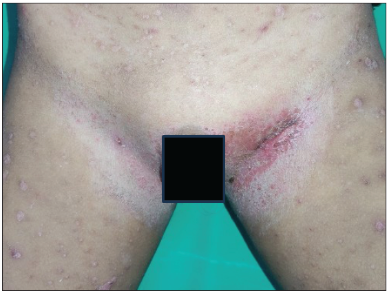 Linear plaques with fissuring & moist scales over the bilateral inguinal folds in a 5-year-old male child with MS-LCH.