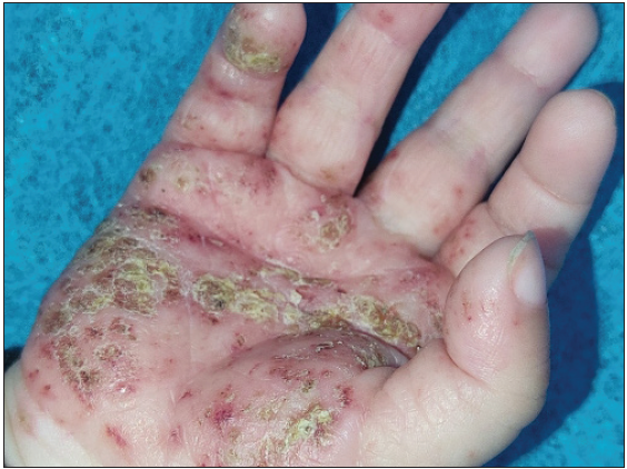 Erythematous papules and plaque along with a yellowish adherent scale crust seen over the right palm in a 1-year-old male child with MS-LCH.