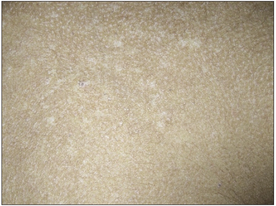 Well-defined hypopigmented macules seen over the upper chest in a 2-year-old male child with MS-LCH.