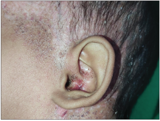 Ear involvement in the form of erythema, crusting, and depigmentation in a 2.5-year-old male child with MS-LCH.