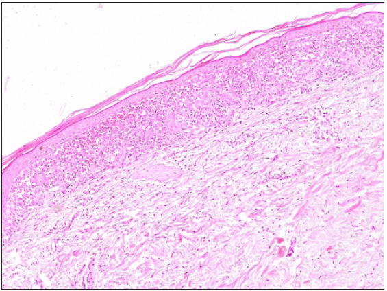 Focal parakeratosis, basket weave to compact stratum corneum, atrophic epidermis with confluent basal cell damage, dense band-like infiltrate of Langerhans cell in the papillary dermis and significant RBC extravasation (Haematoxylin & eosin, 100x).