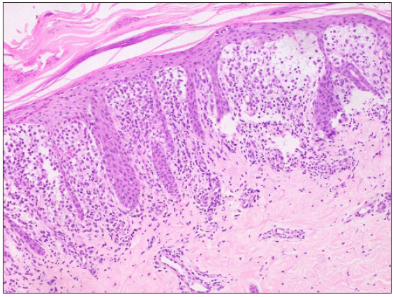 Compact hyperkeratosis, multifocal parakeratosis, epidermal hyperplasia, dense infiltrate of Langerhans cells in the papillary dermis with marked papillary dermal oedema (Haematoxylin & eosin, 200x) eyepiece 10x and objective 20x (200x).