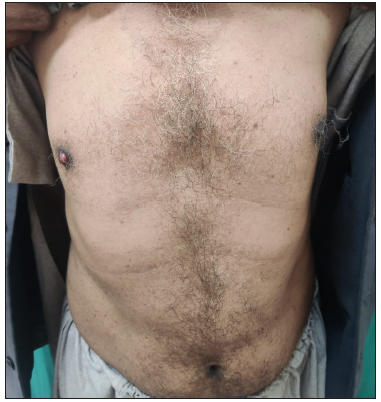 Multiple seborrheic keratoses present over the trunk.