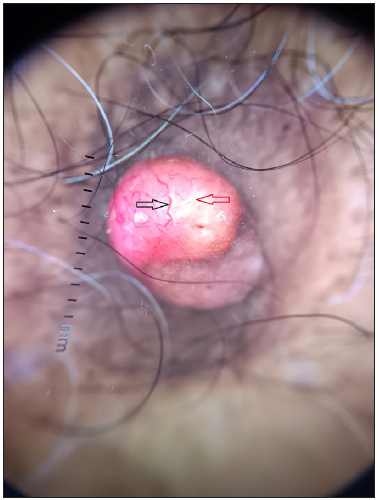 Dermoscopy showing branching arborising vessels (black arrow) of variable diameter against a pink background with interspersed white structureless areas (red arrow). (Dermlite DL4, polarised mode,10x)