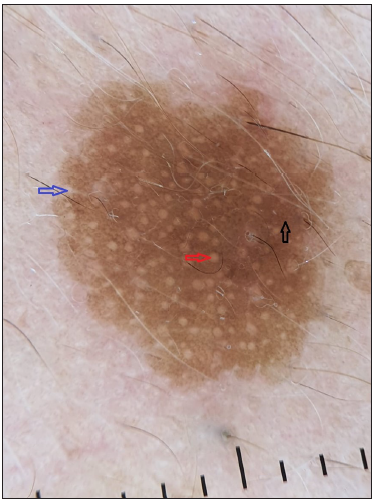 Dermoscopy showing milia-like cysts (red arrow) and moth-eaten borders (blue arrow) and pigment network (black arrow). (Dermlite DL4, polarised mode,10x)