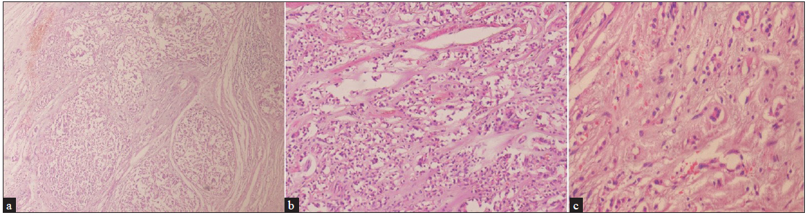 Histopathological examination showing cells scattered individually. High-power view showing pleomorphic cells in sheets with increased nuclear-cytoplasmic ratio (N/C ratio), irregular nuclear contours, prominent nucleoli, and scant mitosis (Haematoxylin & eosin; (a) 40x, (b) 100x and (c) 400x).