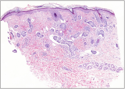 Numerous small nodules and cords of basaloid cells infiltrating between dermal collagen bundles (Haematoxylin & eosin, 40x).