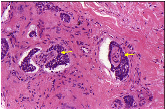 Extensive perineural invasion is observed (yellow arrows) (Haematoxylin & eosin, 400x).