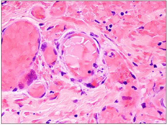 Punch biopsy of the skin showing oblong, crystalline eosinophilic pink deposits occluding the blood vessels in the superficial and deep dermis (Haematoxylin and eosin, 400×).