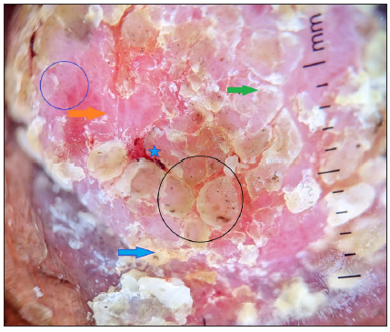 Dermoscopy (DermLite DL4, polarised, 10x) showing a pinkish-orange background, yellow scales (blue arrow) and white scales (green arrow), dotted vessels (blue circle), blood spots (blue star), brown peppering (black circle), chrysalis like structure (orange arrow).