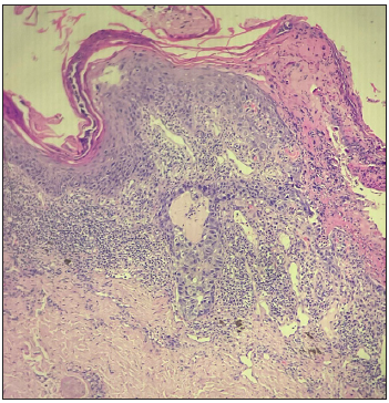 Histopathological examination (Haematoxylin & eosin, 10x) showing intraepidermal collection of malignant cells.