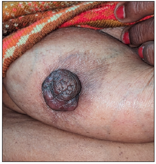 Clinical image showing a well-defined firm brown plaque tethered to the nipple distorting the morphology.
