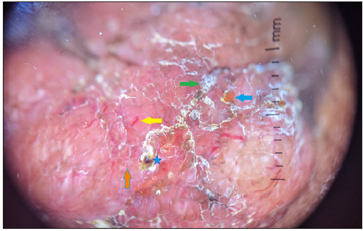 Dermoscopy (DermLite DL4, polarised, 10x) showing pinkish-orange background, yellow scale (blue arrow) and white scale (green arrow), linear vessels (yellow arrow), blood spots (blue star), chrysalis-like structure (orange arrow).