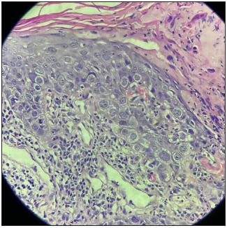 Histopathological examination (Haematoxylin & eosin, 40x) showing large pale cells with eosinophilic cytoplasm and prominent nuclei (Paget cells) forming duct-like nests in the basal and supra-basal layers. Prominent collagen bundles could be seen in the dermis.