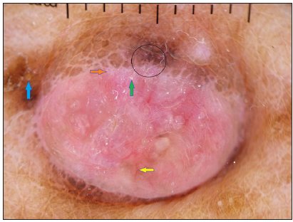 Dermoscopy (DermLite DL4, polarised, 10x) showing pinkish-orange background, yellow scales (blue arrow), white scales (green arrow), linear vessels (yellow arrow), brown peppering (black circle) chrysalis-like structure (orange arrow).