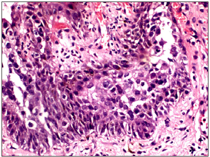 Histopathological examination (Haematoxylin & eosin, 40x) confirming Paget’s cells with abundant pale cytoplasm and phagocytosed melanin seen inside and around the cells. The cells have large irregular nuclei with prominent nucleoli and vague gland formation is noted. Here, too, the prominent collagen bundles can be seen.